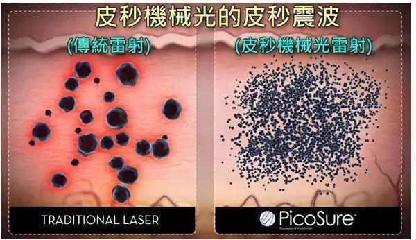 传统镭射和皮秒镭射效果对比图